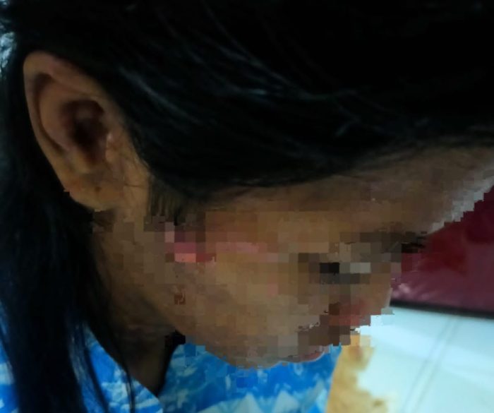 Ibu di Batam Aniaya Anak Tiri Sampai Luka Robek di Wajah Gegara Sering Buang Makanan